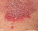 hailey-hailey disease