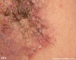 hailey-hailey disease