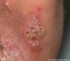 hailey-hailey disease