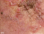 hailey-hailey disease