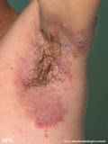 hailey-hailey disease