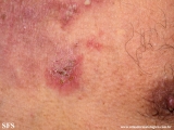 hailey-hailey disease