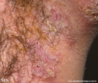 hailey-hailey disease