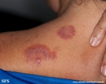 hailey-hailey disease