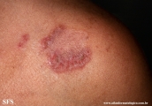 hailey-hailey disease