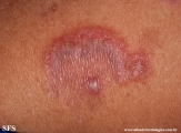 hailey-hailey disease