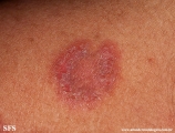 hailey-hailey disease