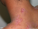 hailey-hailey disease