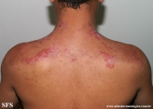 hailey-hailey disease