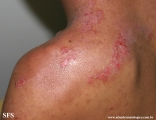 hailey-hailey disease