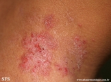 hailey-hailey disease