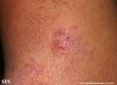 hailey-hailey disease
