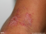 hailey-hailey disease