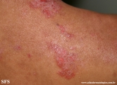 hailey-hailey disease