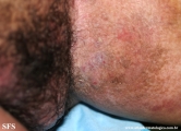 hailey-hailey disease
