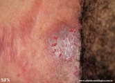 hailey-hailey disease
