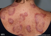 hailey-hailey disease