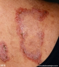 hailey-hailey disease