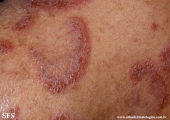 hailey-hailey disease