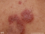 hailey-hailey disease