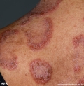 hailey-hailey disease