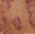 hailey-hailey disease