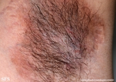 hailey-hailey disease