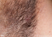 hailey-hailey disease