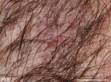 hailey-hailey disease