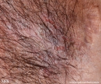 hailey-hailey disease