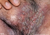 hailey-hailey disease