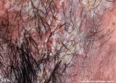 hailey-hailey disease