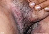 hailey-hailey disease