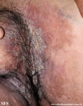 hailey-hailey disease