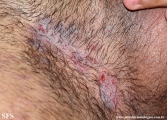 hailey-hailey disease