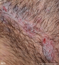 hailey-hailey disease