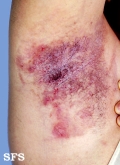 hailey-hailey disease