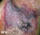 hailey-hailey disease
