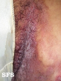 hailey-hailey disease