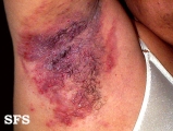hailey-hailey disease