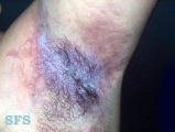hailey-hailey disease