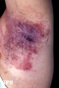 hailey-hailey disease