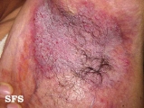 hailey-hailey disease