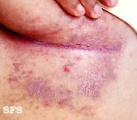 hailey-hailey disease