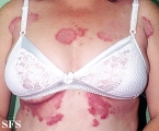 hailey-hailey disease