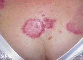 hailey-hailey disease