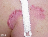 hailey-hailey disease