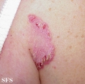 hailey-hailey disease