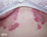hailey-hailey disease