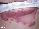 hailey-hailey disease